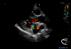 僧帽弁閉鎖不全症　初期エコー